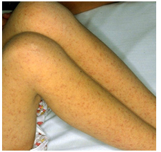 Rocky Mountain Spotted Fever