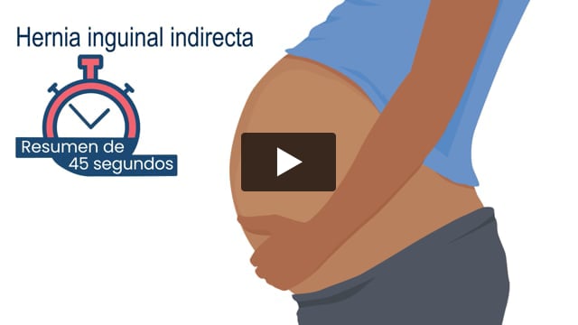 Resumen de 45 segundos: Hernia inguinal indirecta