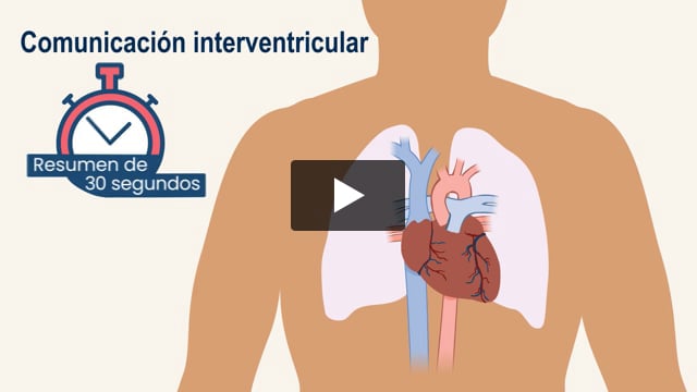 Resumen de 30 segundos: Comunicación interventricular