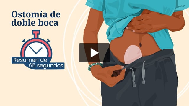 Resumen de 65 segundos: Ostomía de doble boca