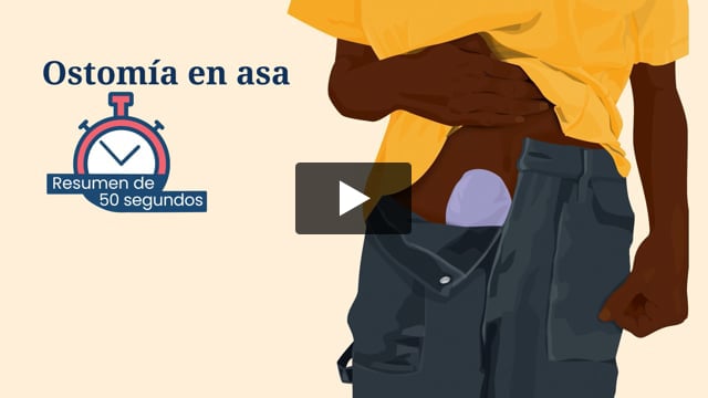 Resumen de 50 segundos: Ostomía en asa