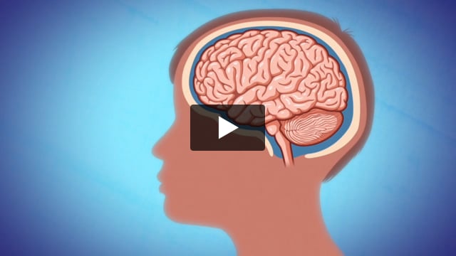 Concussions