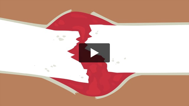 How Bones Heal