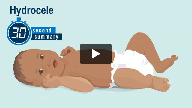 30-Second Summary: Hydrocele