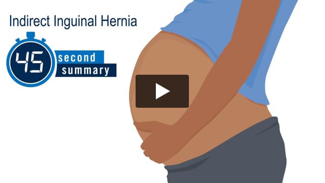45-Second Summary: Indirect Inguinal Hernia