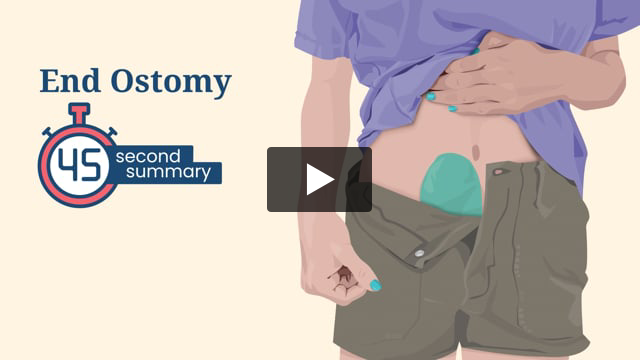 45 Second Summary: End Ostomy