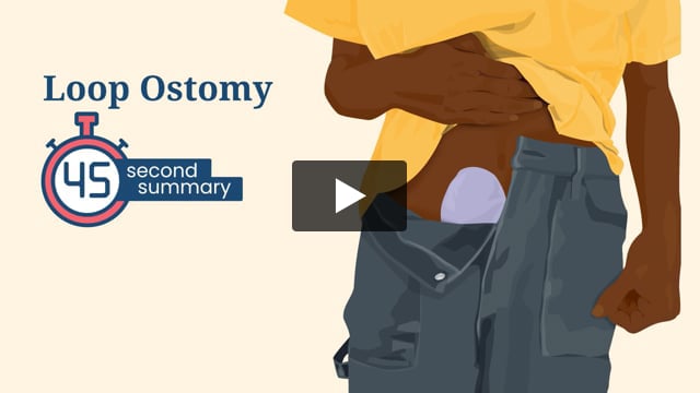 45 Second Summary: Loop Ostomy