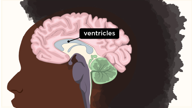 These hollow spaces in the brain have cerebral spinal fluid (CSF) in them. CSF flows through the ventricles and around the spine in the spinal column, protecting and nourishing the central nervous system.