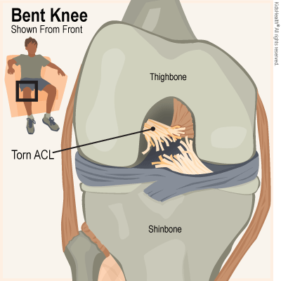 Knee with a torn ACL
