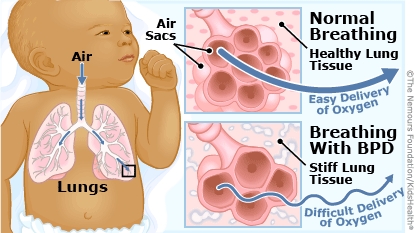 Illustration of a lung tissue for normal breathing in infants and infants breathing with BPD