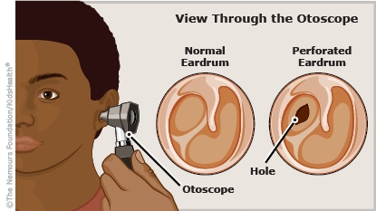 View of a normal eardrum and a perforated eardrum