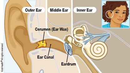 Diagram of the outer ear, middle ear, and inner ear showing earwax (also called cerumen) in the ear canal that leads to the eardrum, as explained in the article.