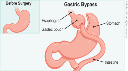 Drawing shows a stomach before and after gastric bypass surgery illustration