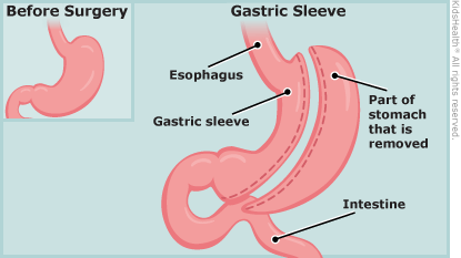Drawing shows a stomach before and after gastric sleeve surgery illustration