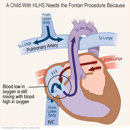 Illustration: A child with HLHS needs the Fontan procedure because
