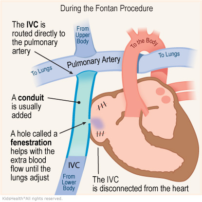 Illustration: During the Fontan Procedure