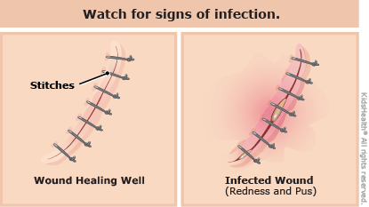 Watch out for signs, like redness and swelling, that a cut might be infected, as described in the article