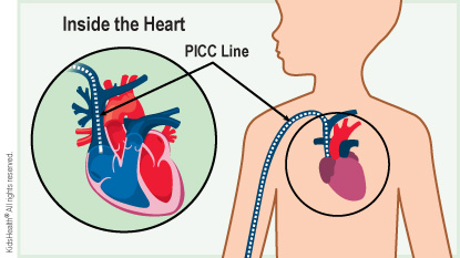 A PICC line is shown under a child's skin near the heart.