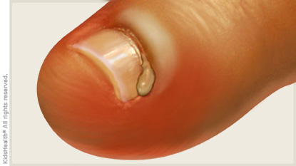 Infection and pus around a fingernail illustration