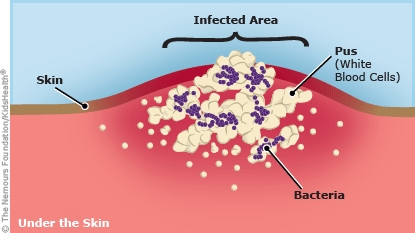 Diagram showing bacteria and pus under the skin, forming an abscess.