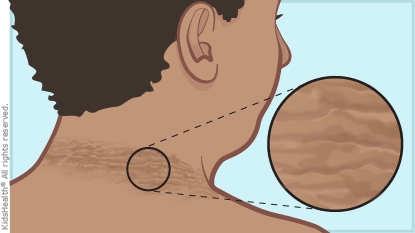 Illustration of acanthosis nicricans - a skin condition that causes dark patches in skin folds