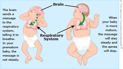Illustration showing the differences in apnea between a premature infant and a more mature infant.