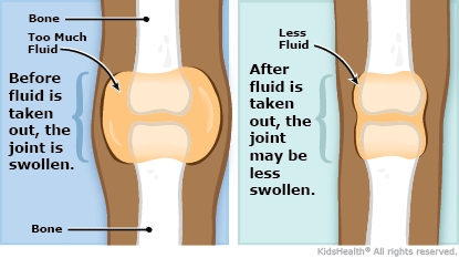 Illustration comparing a joint before and after fluid has been removed.