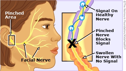 Illustration showing a nerve that's been pinched with the healthy nerve before the pinch and the swollen nerve after the pinch.