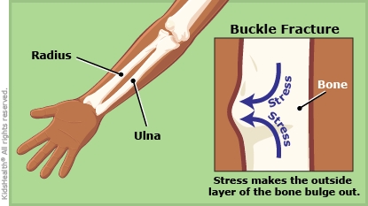 Illustration of a buckle fracture, depicting how stress makes the outer layer of the bone bulge outward