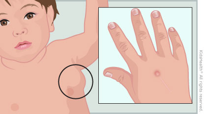 Illustration of an infant with symptoms of cat scratch disease