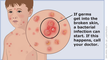 Illustration of how a child would look with chickenpox. If germs get into the broken skin, a bacterial infection can start. If this happens, call your doctor.