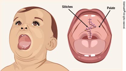 100211_cleftpalate_rd4