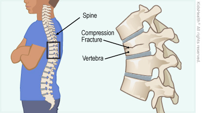  Diagram of the spine showing a compression fracture in one vertebra, as described in the article.　