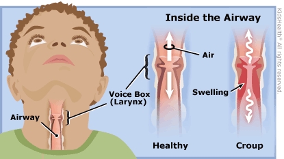 Illustration of how croup effects the airway