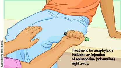 Give an epinephrine injection to treat anaphylaxis right away, as described in the article.