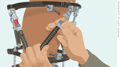 Illustration: Tightening struts on external fixator