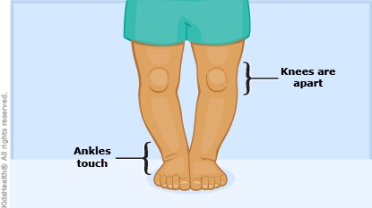 A child with bow legs