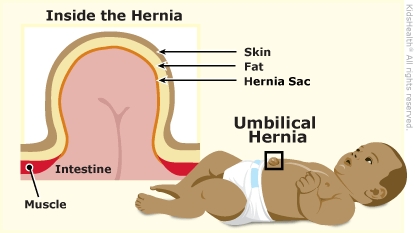 Diagram shows a baby with an umbilical hernia and an inside view of the hernia.