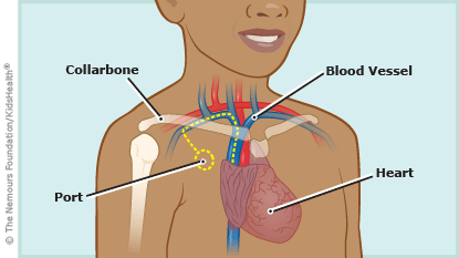 An implanted port shown under a child's skin near the heart.