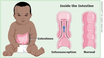 A look inside the intestine with and without intussusception