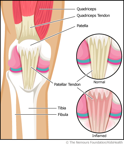 Jumper's Knee 2