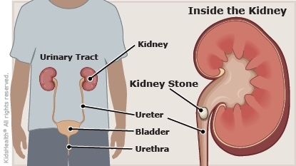 A side look at a kidney stone in the ureter.