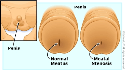 Illustration: meatal stenosis