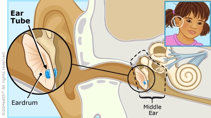 Inner ear with ear tube