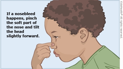 Picture shows a child with a nosebleed pinching the nose and leaning forward
