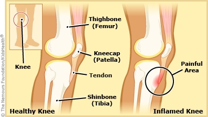 Diagram shows the knee, kneecap, tendon, thighbone, shinbone, and shinbone growth plate. Osgood-Schlatter disease happens when the tendon pulls on the growth plate of the shinbone over and over again