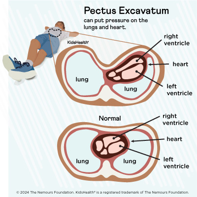 Illustration: Pectus excavatum pressure on heart and lungs