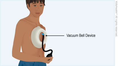 Illustration: Vacuum Bell Device