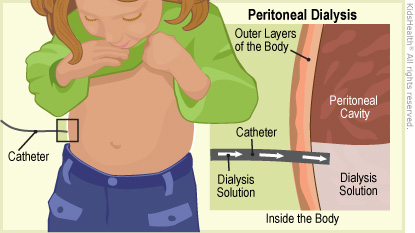Illustration: Peritoneal Dialysis