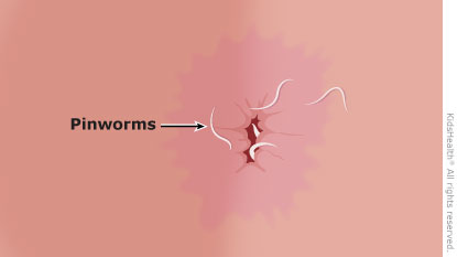  Diagram showing pinworms around the anus.